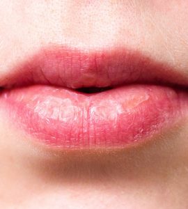 Cracked Mouth Corners can be Irritating - Here's How to Treat Them