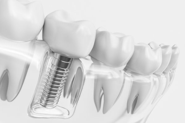 Implant dentaire - Dental Implant - Centre dentaire Dre Nathalie Kadoch à LaSalle