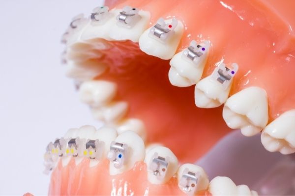 Orthodontie interceptive - Orthodontics - Centre dentaire Dre Nathalie Kadoch à LaSalle (3)