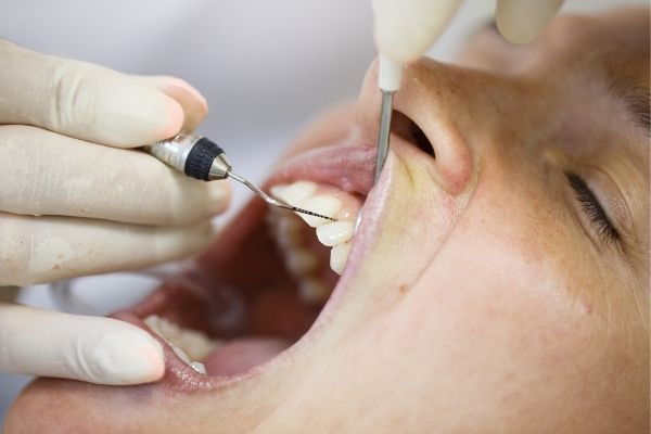 Parodontie - Periodontics - Centre dentaire Nathalie Kadoch a LaSalle