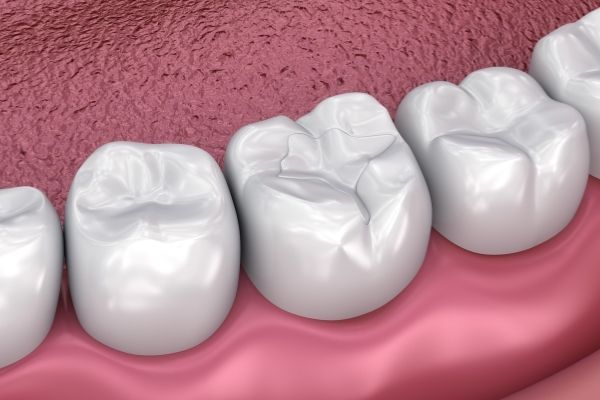 Scellant dentaire - Dental sealant - Centre dentaire Nathalie Kadoch a LaSalle