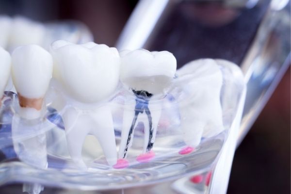 traitement de canal - Teeth rooth canal - Centre dentaire Nathalie Kadoch a LaSalle (1)