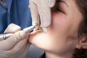 Nécessaire deux nettoyages dentaires par année - Centre dentaire Nathalie Kadoch
